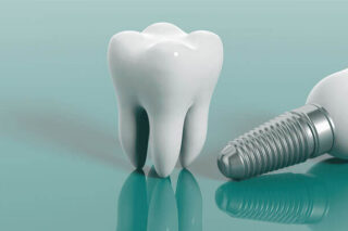 implant-dentar-brasov