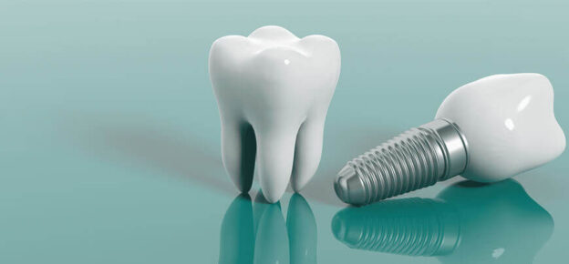 implant-dentar-brasov