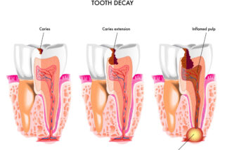 carii-plombe-obturatii-dentare